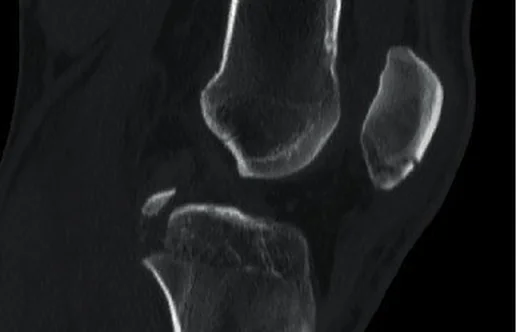 Arka çapraz bağ tibial avulsiyonu: yayımlanmış olgu görüntüsü, sagittal kesit