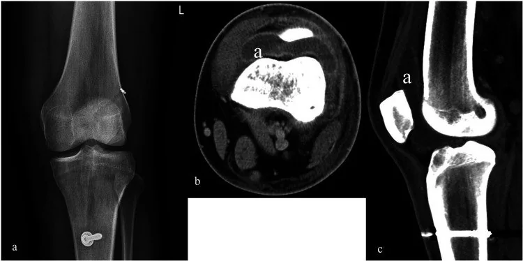 Septik diz artritinde BT bulguları: yayımlanmış olgu görüntüsü, aksiyel+sagittal kesit