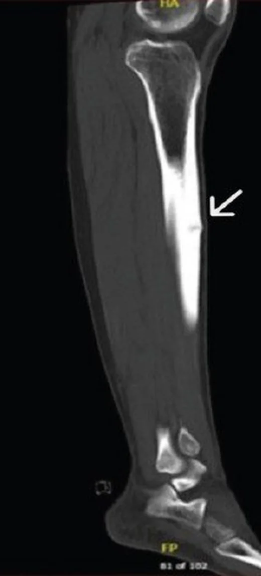 Tibia stres/yetersizlik kırığı: yayımlanmış olgu görüntüsü, sagittal kesit