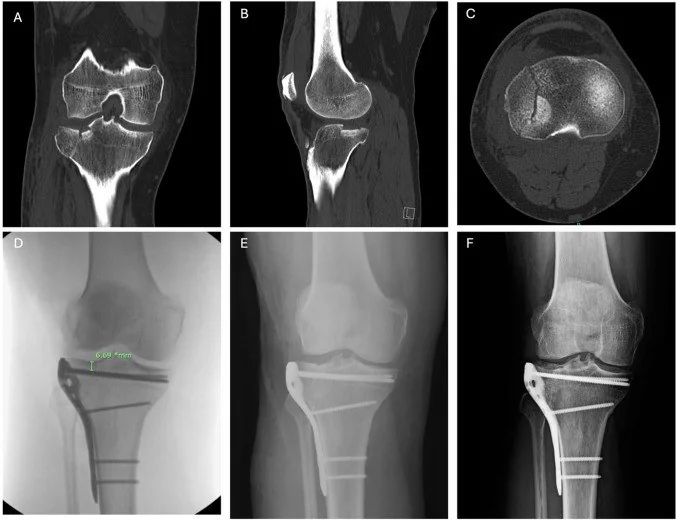 Tibia platosu lateral split kırığı: yayımlanmış olgu görüntüsü, aksiyel kesit