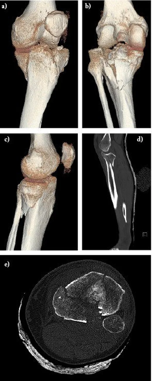 Medial ve bikondiler tibia plato kırıkları: yayımlanmış olgu görüntüsü, 3B kesit