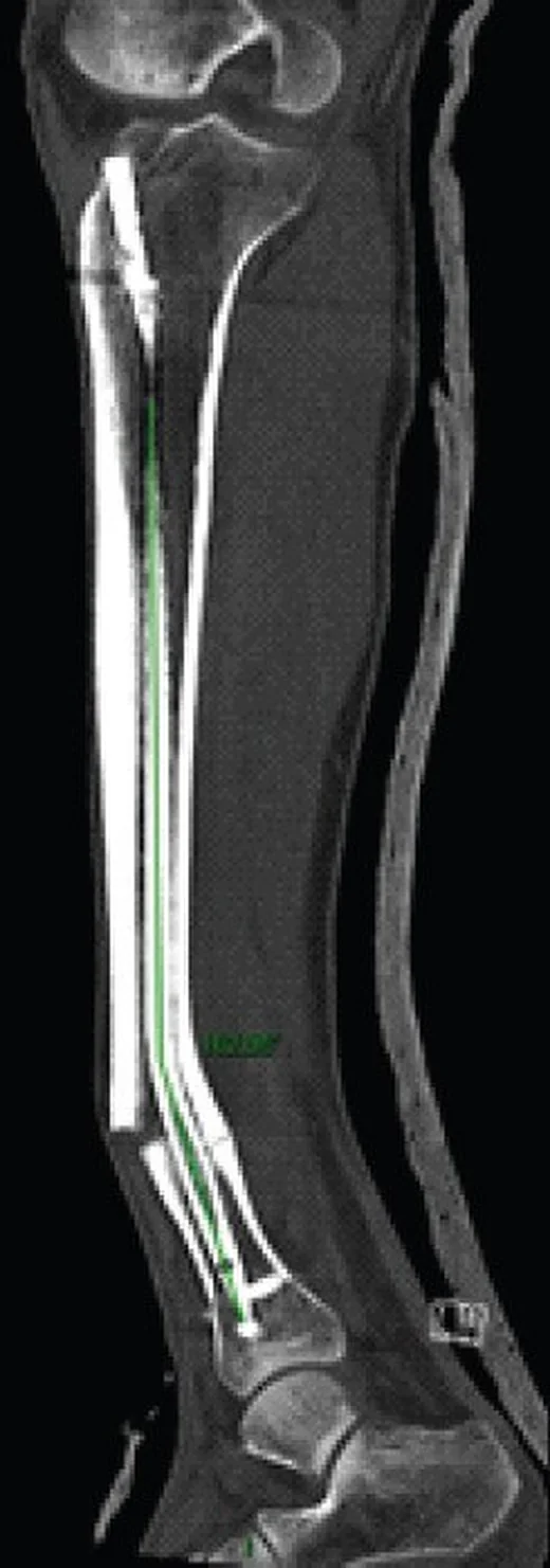 Tibia şaft kırığı: yayımlanmış olgu görüntüsü, sagittal kesit