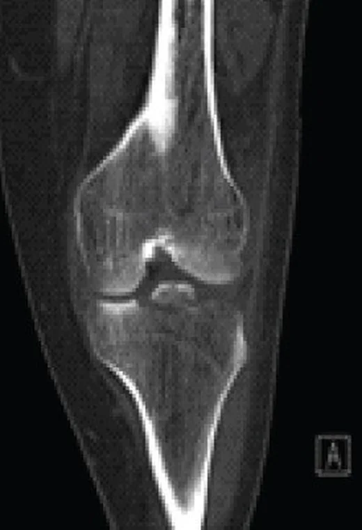 Tibial eminens avulsiyonu: yayımlanmış olgu görüntüsü, sagittal kesit