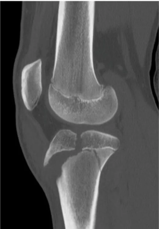 Tibial tüberkül avulsiyon kırığı: yayımlanmış olgu görüntüsü, sagittal kesit