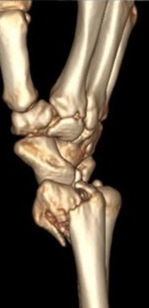 Barton kırığı (dorsal/volar rim): yayımlanmış olgu görüntüsü, 3B kesit