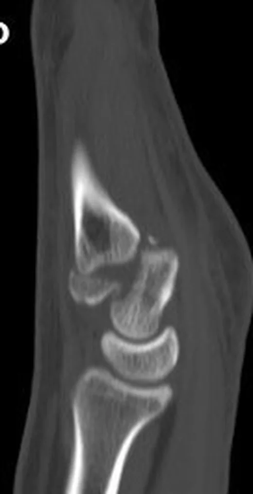 Capitatum kırığı: yayımlanmış olgu görüntüsü, koronal-sagittal kesit