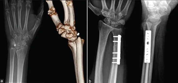 Distal radius malunion ve posttravmatik deformite: yayımlanmış olgu görüntüsü, 3B kesit
