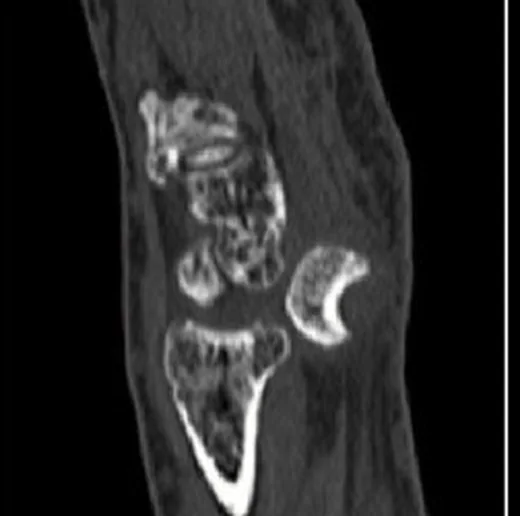 Lunatum çıkığı: yayımlanmış olgu görüntüsü, sagittal kesit