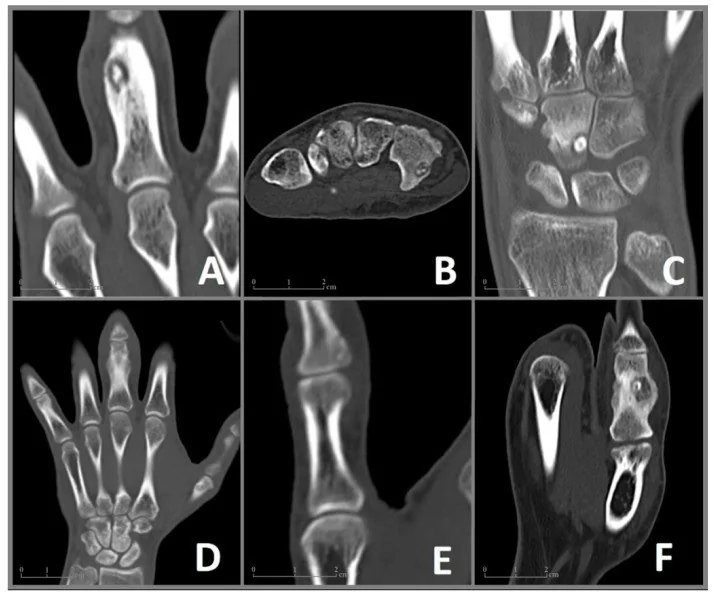 Karpal osteoid osteoma: yayımlanmış olgu görüntüsü, aksiyel kesit