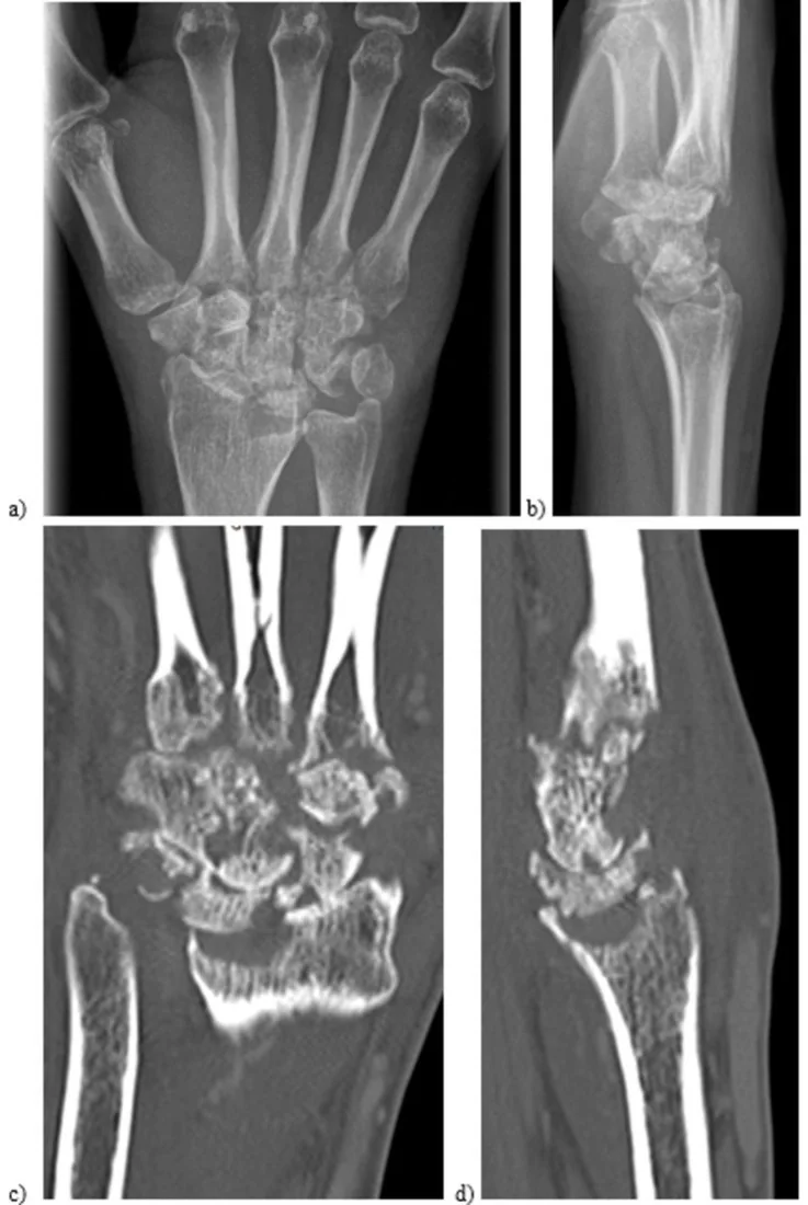 El bileği ve el septik artriti: yayımlanmış olgu görüntüsü, koronal+sagittal kesit
