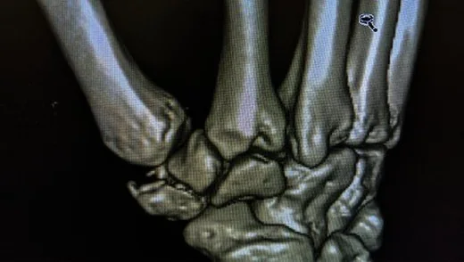 Trapezium kırığı: yayımlanmış olgu görüntüsü, 3B kesit