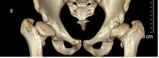 Asetabular displazi ve femur başı yetersiz örtünmesi: yayımlanmış olgu görüntüsü, çoklu kesit