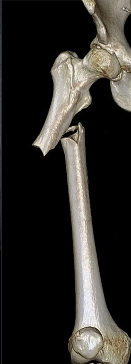 Atipik femur kırığı: yayımlanmış olgu görüntüsü, 3B kesit