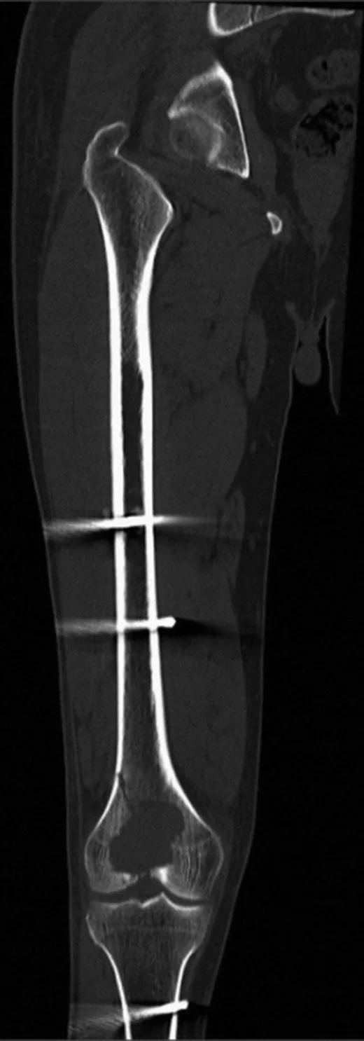 Femur dev hücreli tümörü: yayımlanmış olgu görüntüsü, koronal kesit