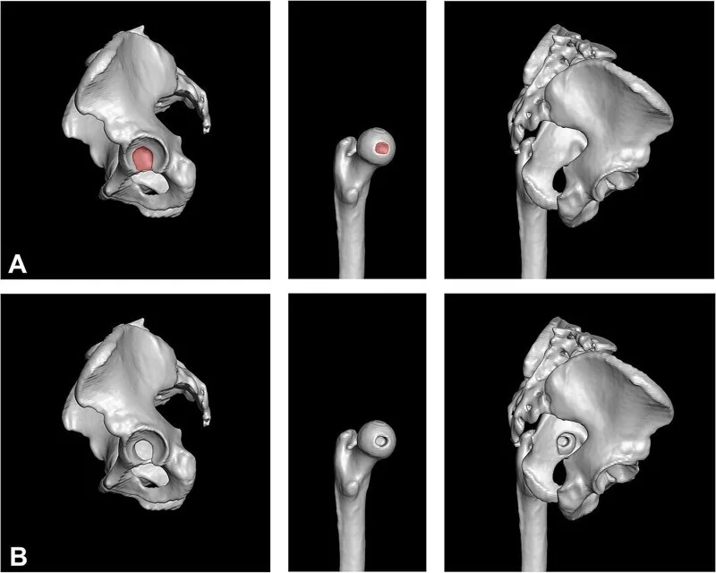 Fovea capitis — ligamentum teres tutunma çukuru: yayımlanmış olgu görüntüsü, 3B kesit