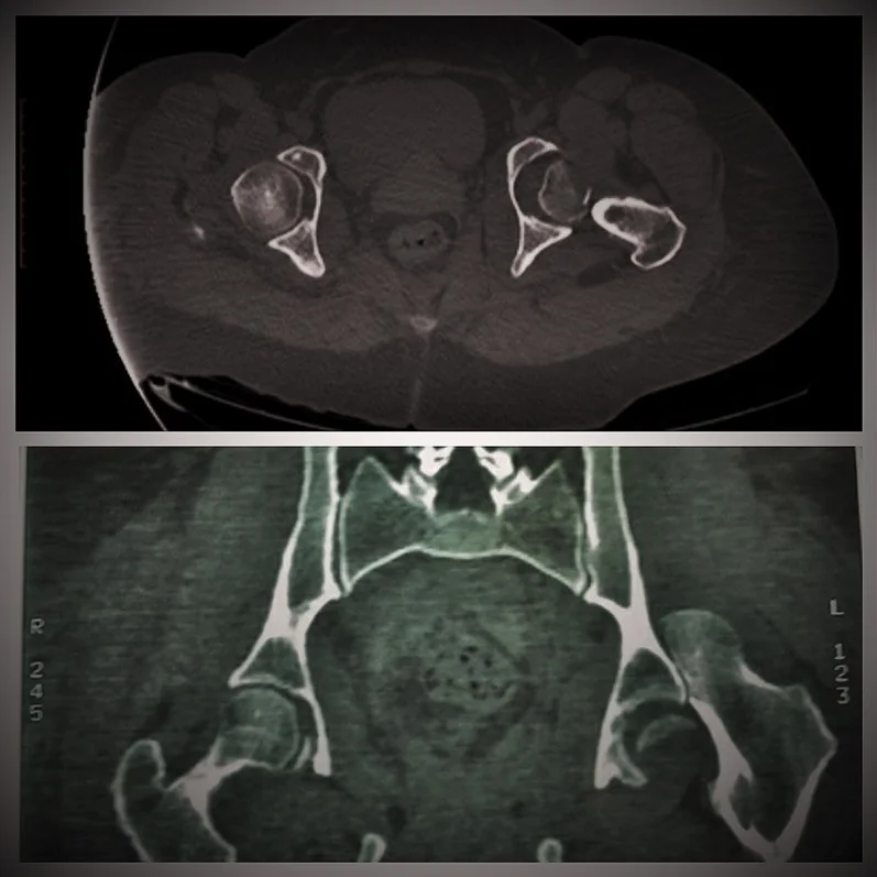 Femur başı kırığı (Pipkin): yayımlanmış olgu görüntüsü, aksiyel kesit