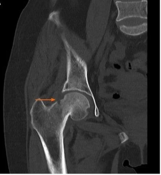Femur boyun kırığı: yayımlanmış olgu görüntüsü, koronal kesit