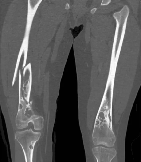 Femur non-ossifying fibroması: yayımlanmış olgu görüntüsü, koronal kesit