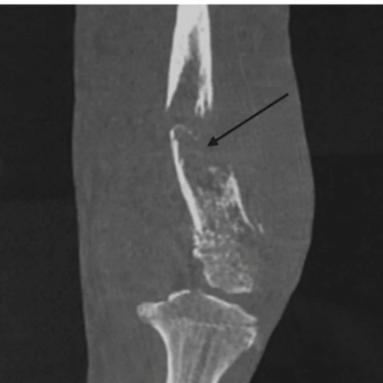Femur primer kemik lenfoması: yayımlanmış olgu görüntüsü, sagittal kesit
