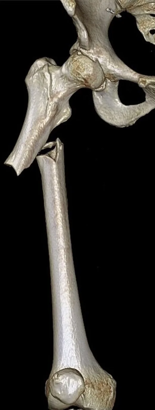Femur cisim kırığı: yayımlanmış olgu görüntüsü, 3B kesit