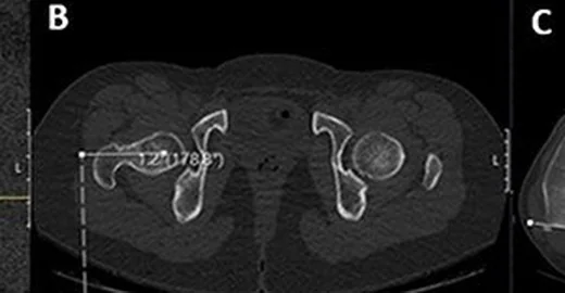 Femoral anteversiyon/retroversiyon ve torsiyon ölçümü: yayımlanmış olgu görüntüsü, aksiyel kesit