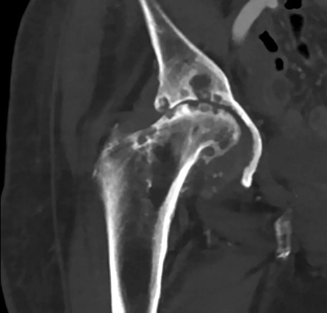 Kalça osteoartriti: yayımlanmış olgu görüntüsü, koronal kesit