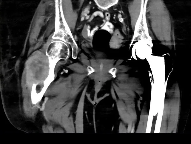Femur metastazı: yayımlanmış olgu görüntüsü, aksiyel kesit