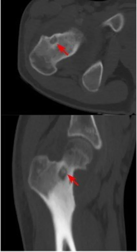 Femur osteoid osteoması: yayımlanmış olgu görüntüsü, aksiyel kesit