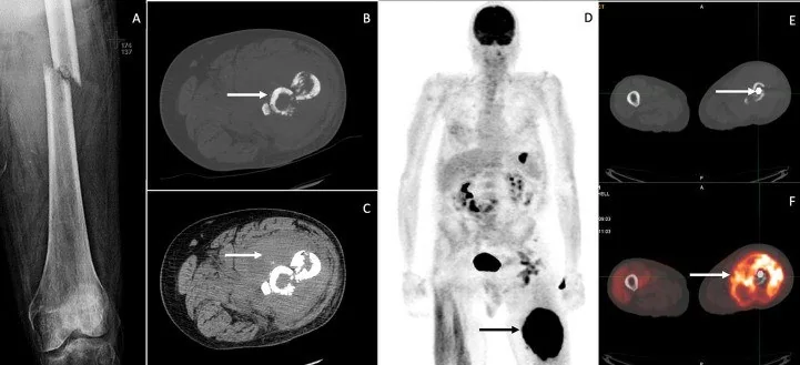 Femur patolojik kırığı: yayımlanmış olgu görüntüsü, aksiyel kesit