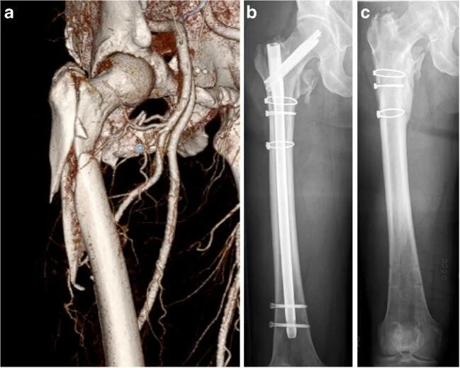 Subtrokanterik femur kırığı: yayımlanmış olgu görüntüsü, 3B kesit