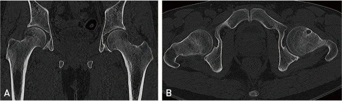 Femur boynu sinovyal herniasyon çukuru: yayımlanmış olgu görüntüsü, koronal kesit