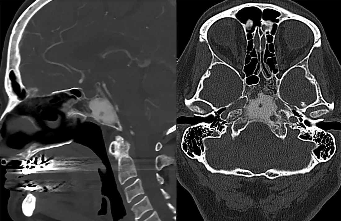 Benign ve agresif kemik lezyonlarının BT özellikleri: yayımlanmış olgu görüntüsü, sagittal kesit