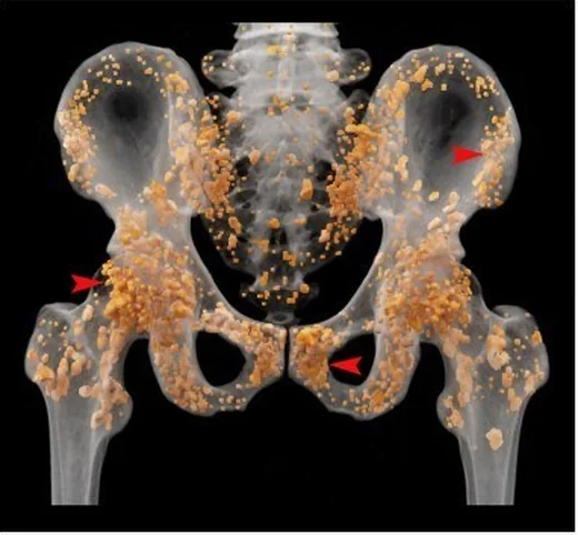 Osteopoikiloz: yayımlanmış olgu görüntüsü, koronal kesit