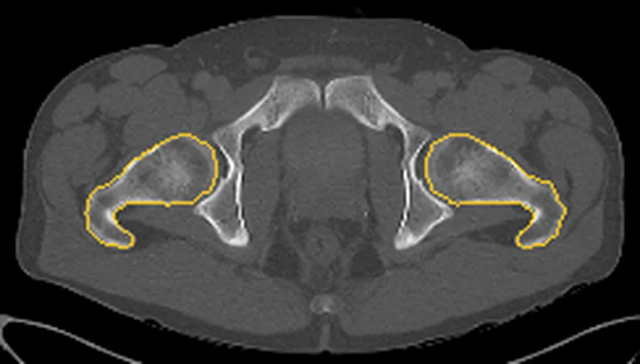 Bölge anatomisi, BT kesiti: Femur sınırı sarı çizgiyle işaretli