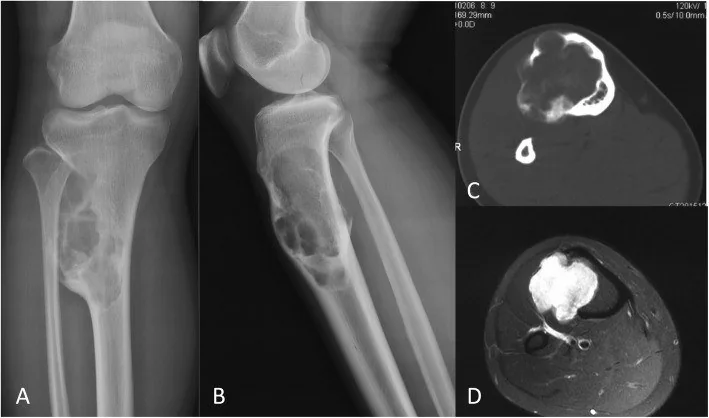 Osteofibröz displazi: yayımlanmış olgu görüntüsü, aksiyel kesit