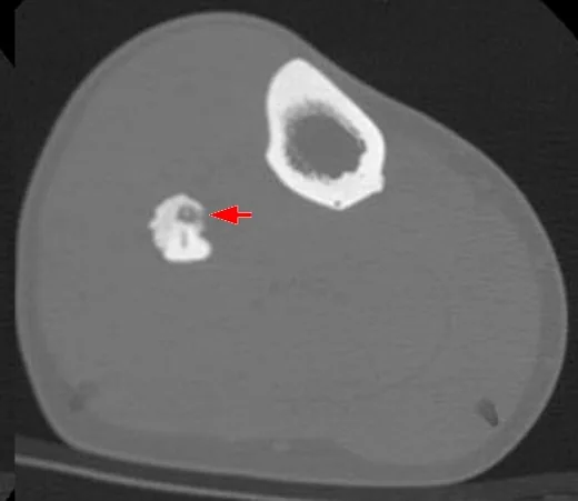 Osteoid osteom: yayımlanmış olgu görüntüsü, aksiyel kesit
