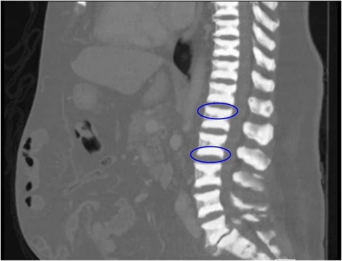 Osteopetroz: yayımlanmış olgu görüntüsü, sagittal kesit