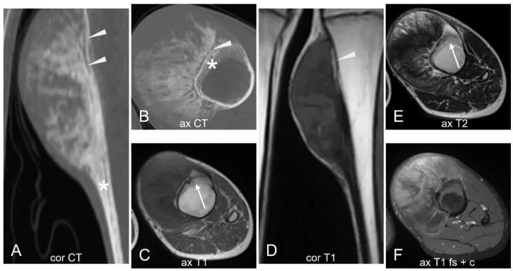Parosteal osteosarkom: yayımlanmış olgu görüntüsü, koronal kesit