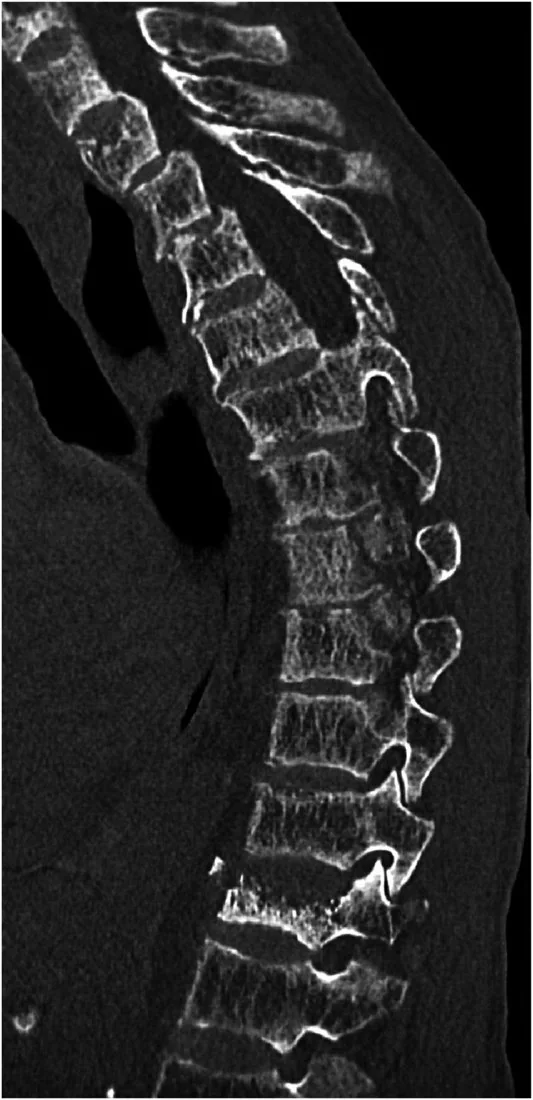 Renal osteodistrofi: yayımlanmış olgu görüntüsü, sagittal kesit