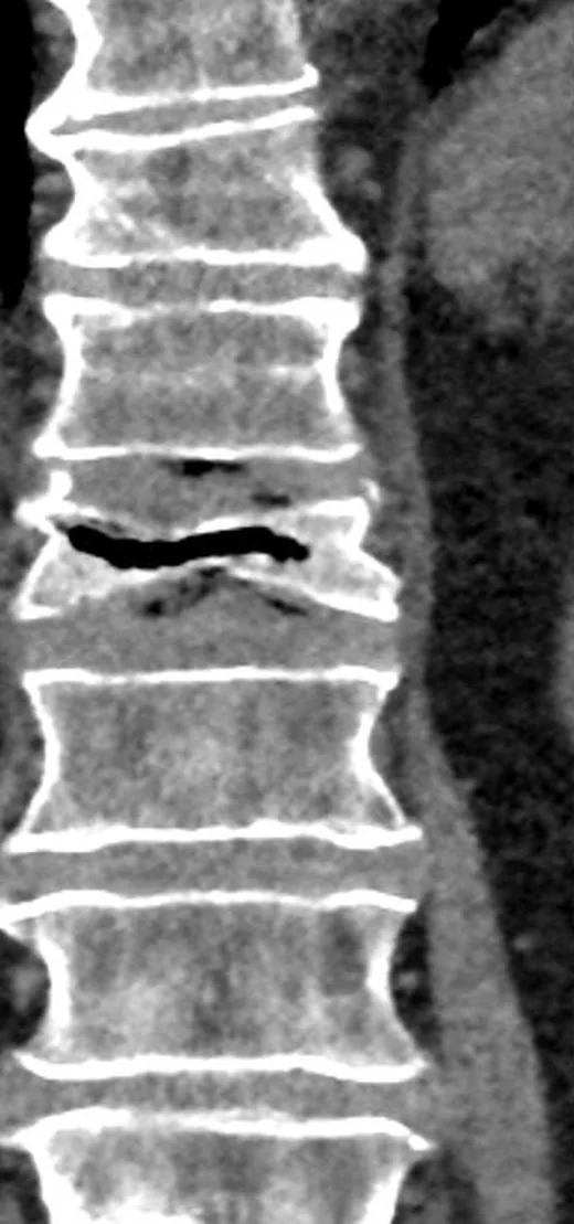 Vertebra kompresyon kırığı: yayımlanmış olgu görüntüsü, sagittal kesit