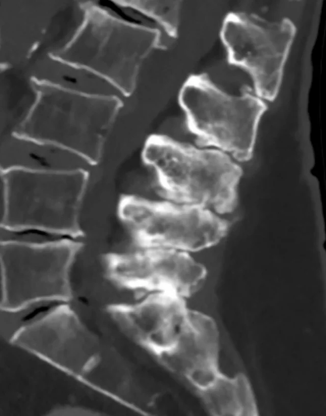 Baastrup hastalığı (öpüşen spinöz çıkıntılar): yayımlanmış olgu görüntüsü, sagittal kesit