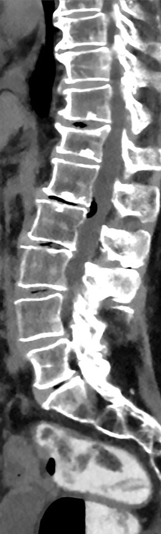 İntervertebral disk dejenerasyonu ve vakum fenomeni: yayımlanmış olgu görüntüsü, aksiyel+sagittal kesit