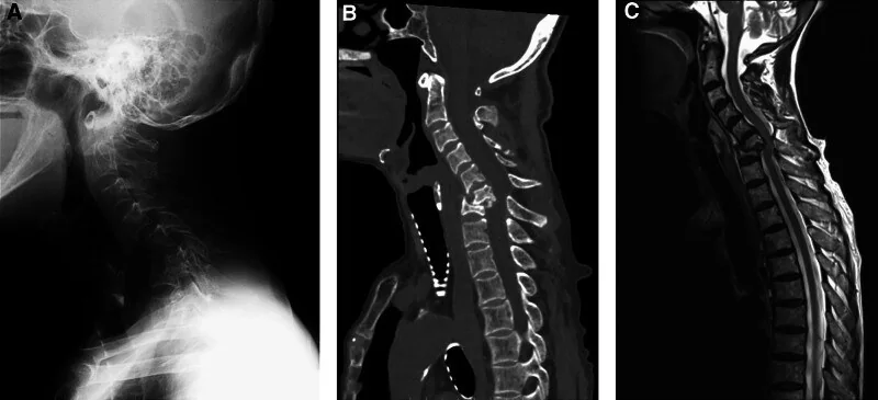 Diyaliz ilişkili yıkıcı spondiloartropati: yayımlanmış olgu görüntüsü, sagittal kesit