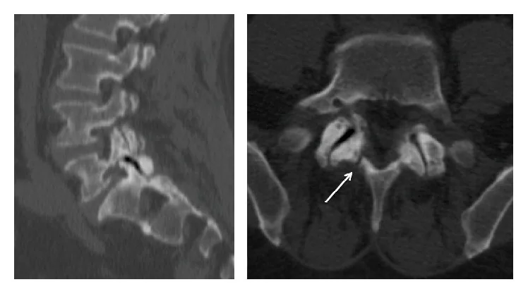Faset eklem osteoartriti: yayımlanmış olgu görüntüsü, aksiyel kesit