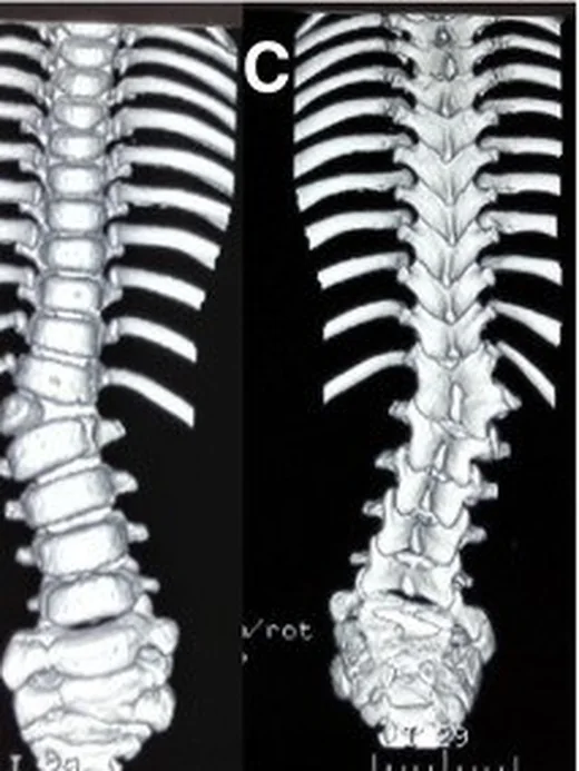 Hemivertebra ve konjenital kama vertebra: yayımlanmış olgu görüntüsü, 3B kesit