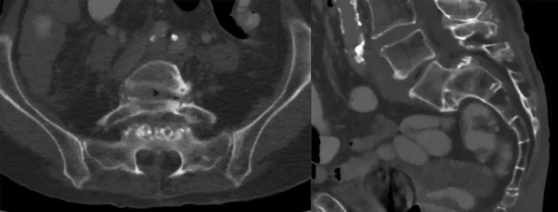 İstmik spondilolistezis: yayımlanmış olgu görüntüsü, sagittal kesit