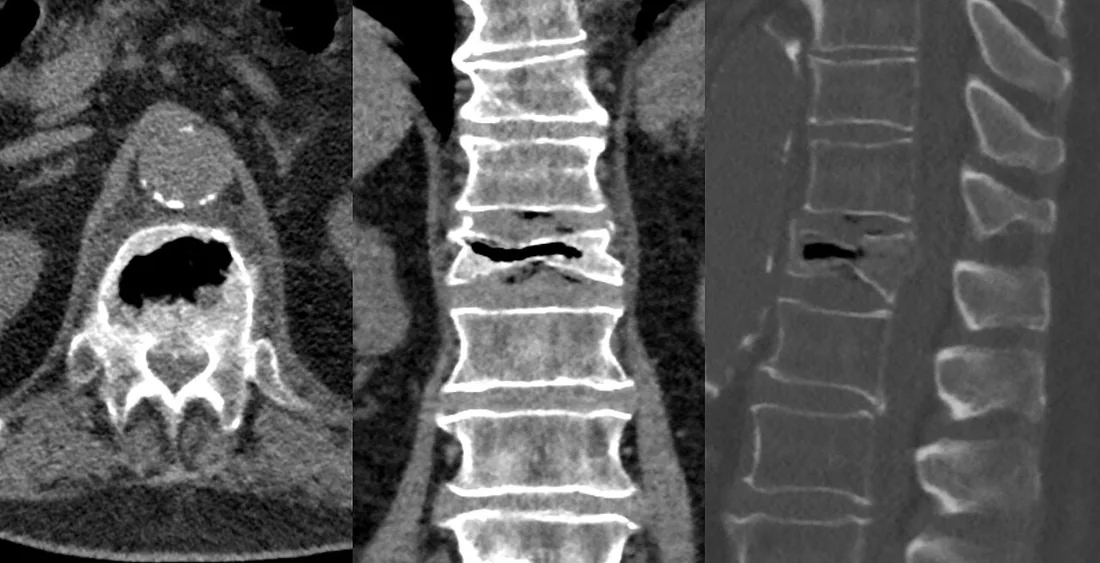 Kümmell hastalığı / vertebral osteonekroz: yayımlanmış olgu görüntüsü, sagittal kesit