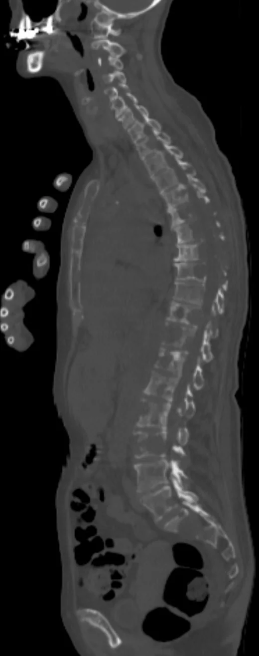 Vertebral litik metastaz: yayımlanmış olgu görüntüsü, sagittal kesit