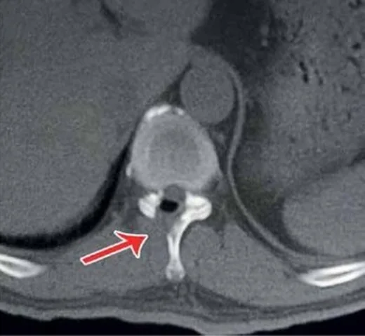 Ligamentum flavum ossifikasyonu (OLF): yayımlanmış olgu görüntüsü, aksiyel kesit