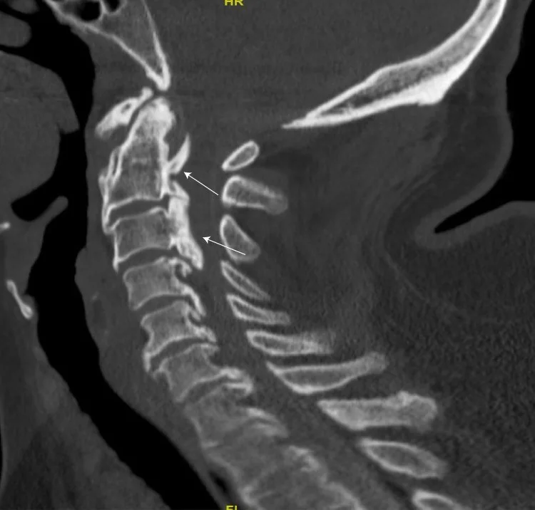 Posterior longitudinal ligament ossifikasyonu (OPLL): yayımlanmış olgu görüntüsü, sagittal kesit